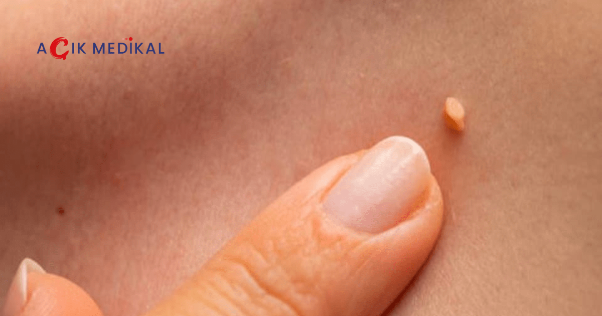 HPV Nedir? Belirtileri, Bulaşma Yolları ve Korunma Rehberi